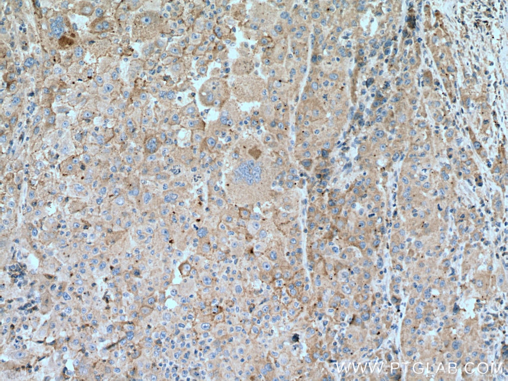 Immunohistochemistry (IHC) staining of human liver cancer tissue using CD126/IL-6R alpha Monoclonal antibody (66855-1-Ig)