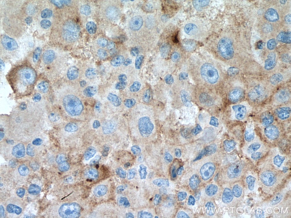 Immunohistochemistry (IHC) staining of human liver cancer tissue using CD126/IL-6R alpha Monoclonal antibody (66855-1-Ig)