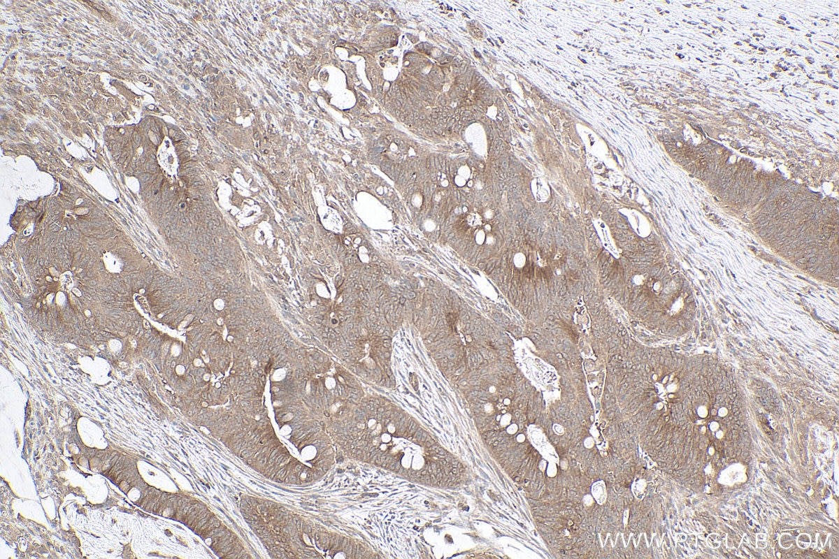 Immunohistochemistry (IHC) staining of human colon cancer tissue using gp130 Monoclonal antibody (67766-1-Ig)