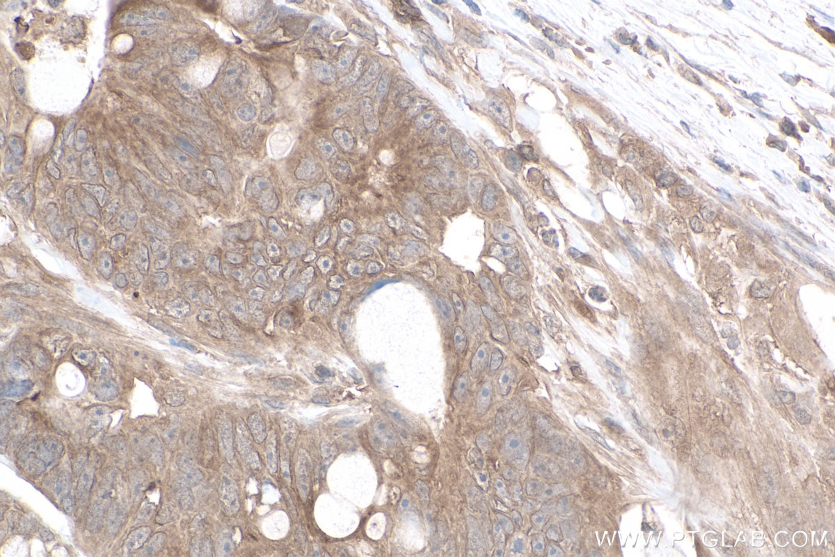 Immunohistochemistry (IHC) staining of human colon cancer tissue using gp130 Monoclonal antibody (67766-1-Ig)