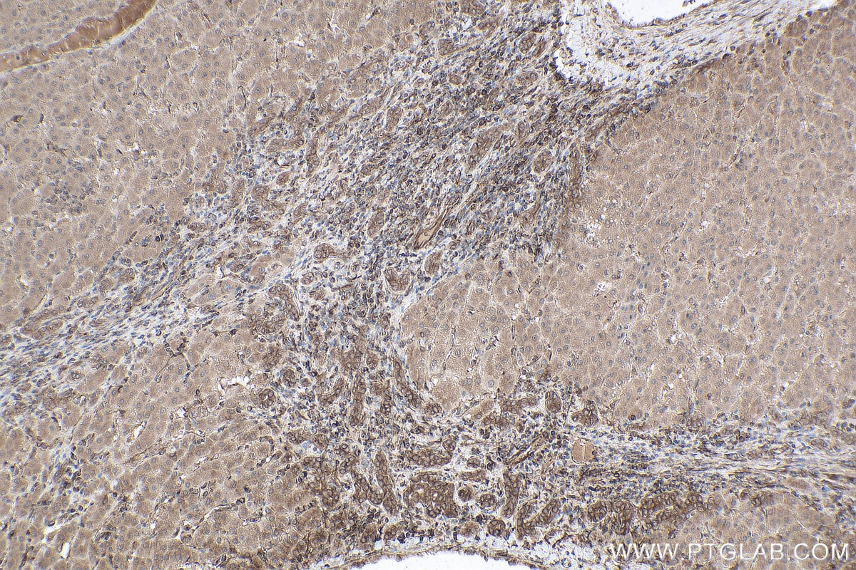 Immunohistochemistry (IHC) staining of human liver cancer tissue using gp130 Monoclonal antibody (67766-1-Ig)