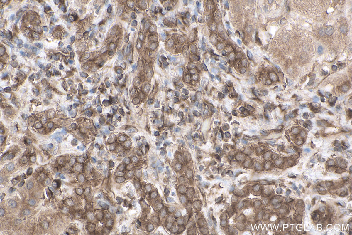 Immunohistochemistry (IHC) staining of human liver cancer tissue using gp130 Monoclonal antibody (67766-1-Ig)