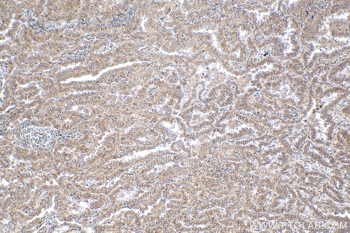Immunohistochemistry (IHC) staining of human lung cancer tissue using gp130 Monoclonal antibody (67766-1-Ig)