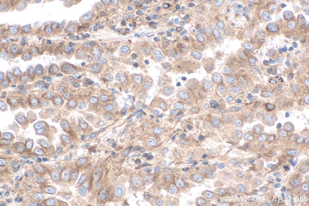 IHC staining of human lung cancer using 67766-1-Ig