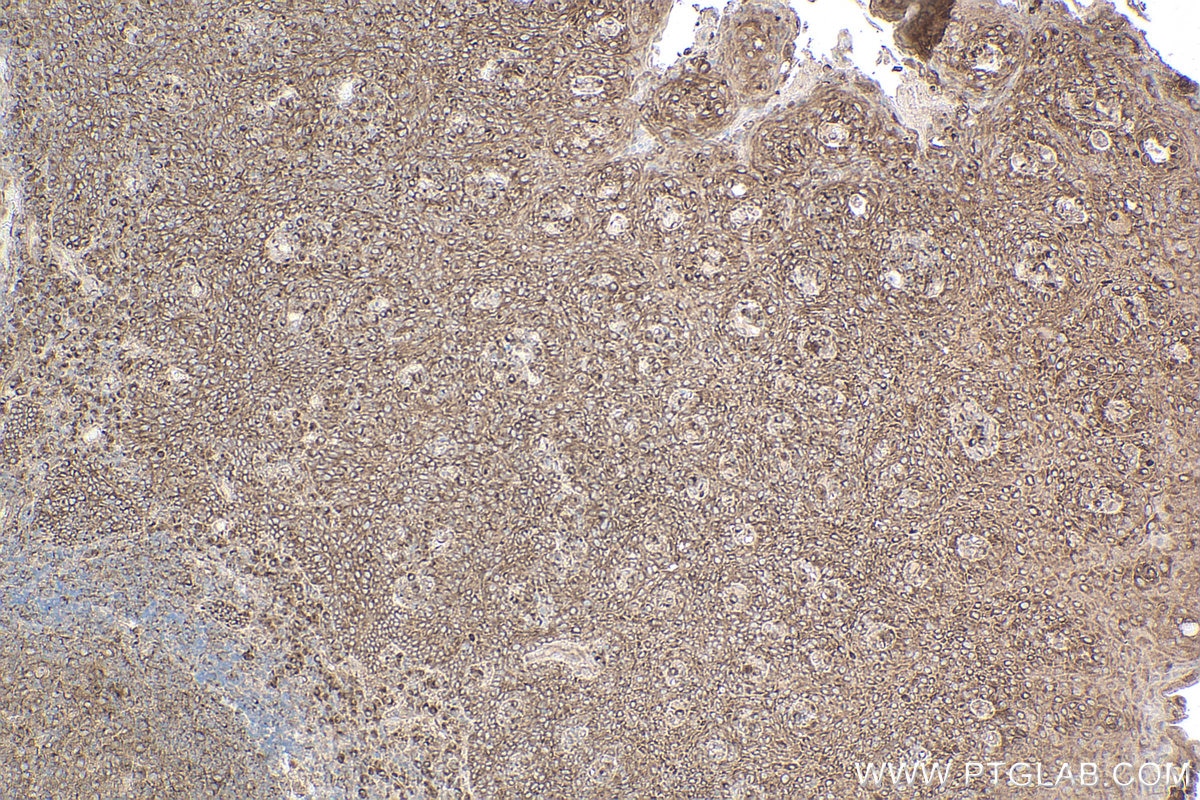Immunohistochemistry (IHC) staining of human tonsillitis tissue using gp130 Monoclonal antibody (67766-1-Ig)