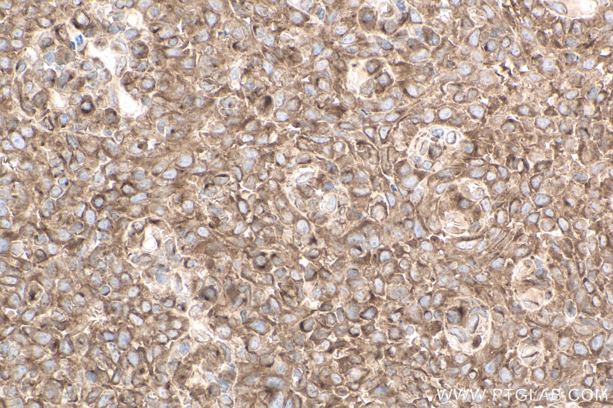 Immunohistochemistry (IHC) staining of human tonsillitis tissue using gp130 Monoclonal antibody (67766-1-Ig)