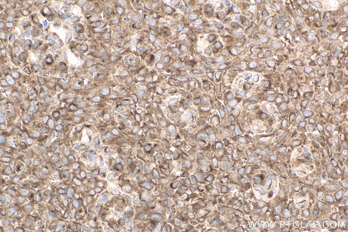 Immunohistochemistry (IHC) staining of human tonsillitis tissue using gp130 Monoclonal antibody (67766-1-Ig)