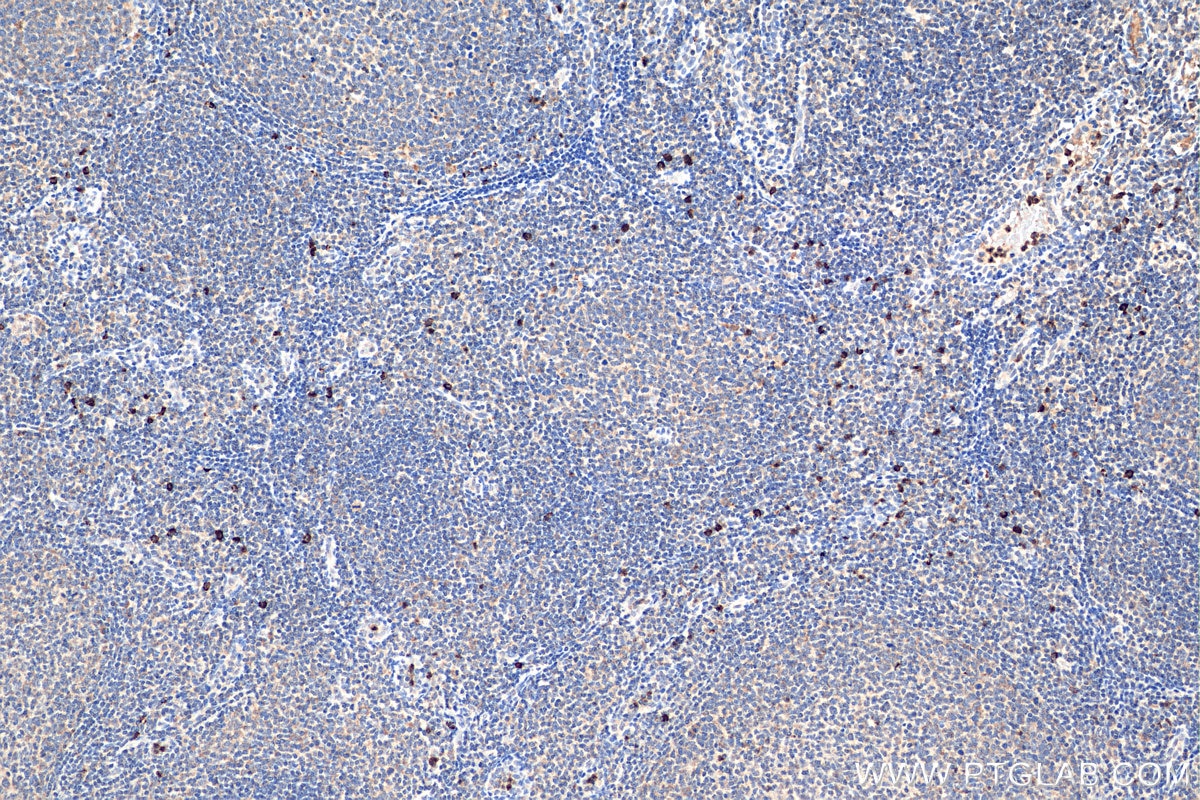 IHC staining of human tonsillitis using 20634-1-AP