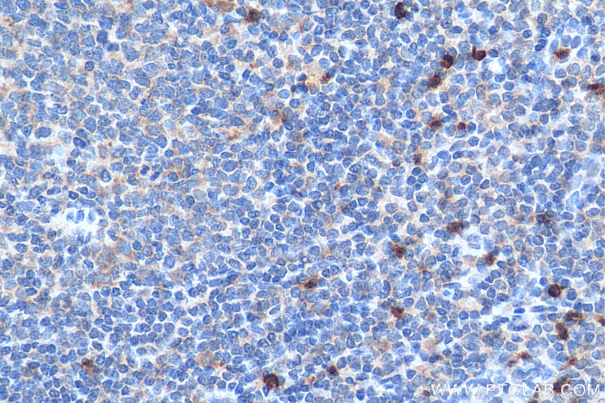 IHC staining of human tonsillitis using 20634-1-AP