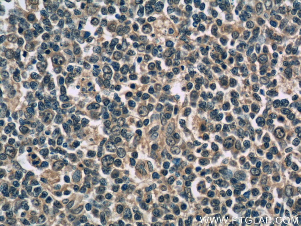 Immunohistochemistry (IHC) staining of human tonsillitis tissue using IL-9 Monoclonal antibody (66144-1-Ig)