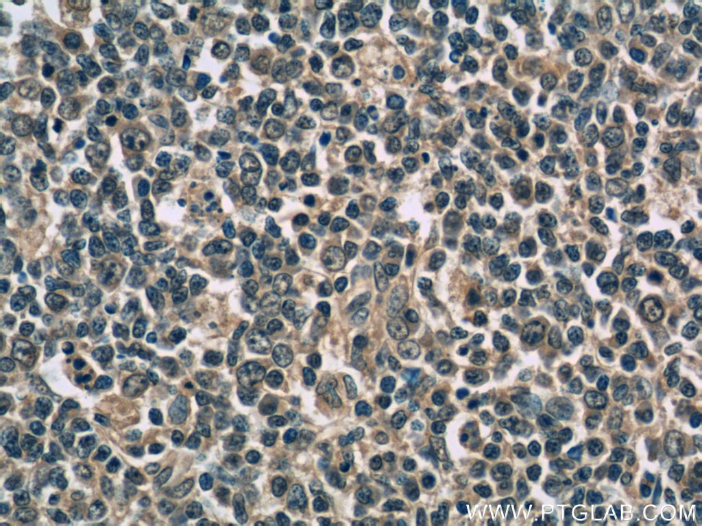 IHC staining of human tonsillitis using 66144-1-Ig