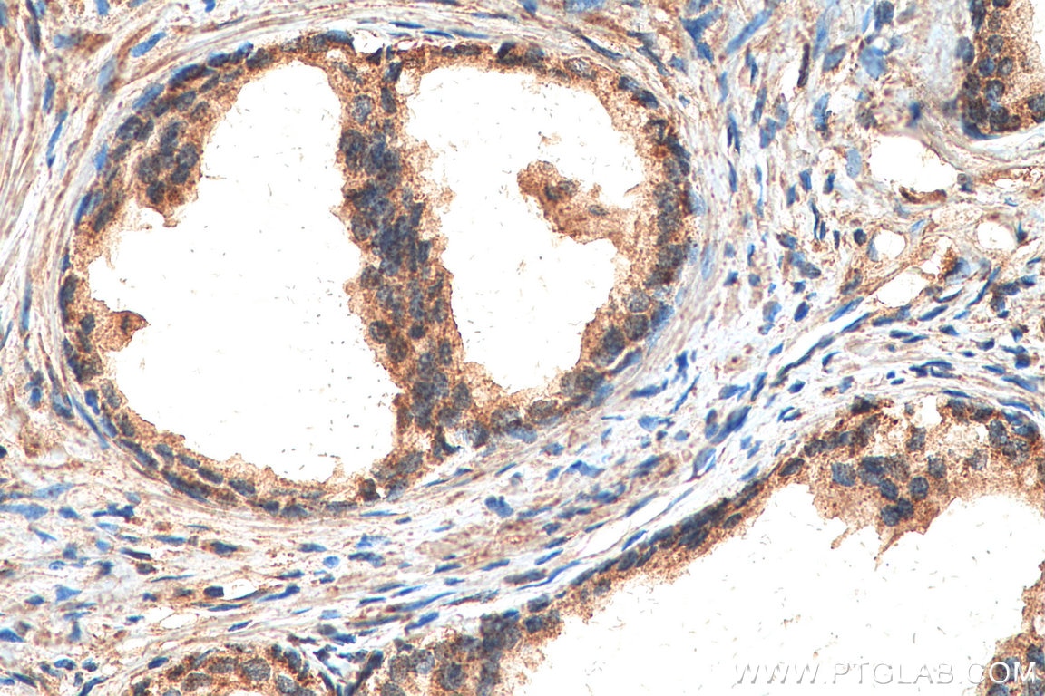 Immunohistochemistry (IHC) staining of human prostate cancer tissue using ILK Polyclonal antibody (12955-1-AP)
