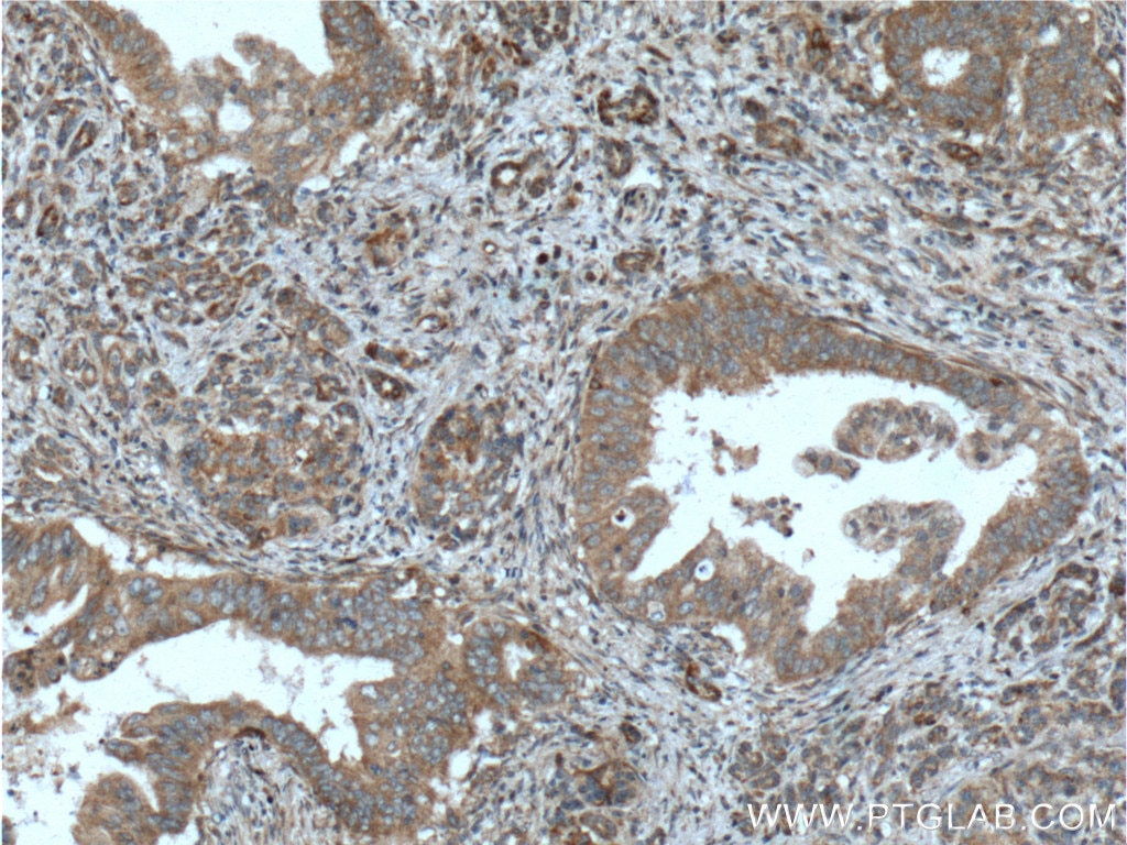 Immunohistochemistry (IHC) staining of human pancreas cancer tissue using ILK Polyclonal antibody (24926-1-AP)