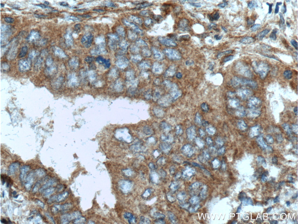 Immunohistochemistry (IHC) staining of human pancreas cancer tissue using ILK Polyclonal antibody (24926-1-AP)