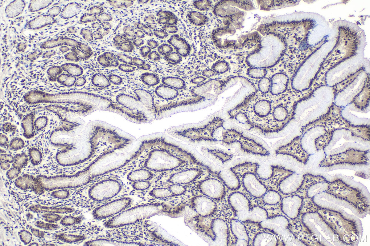 Immunohistochemistry (IHC) staining of human stomach cancer tissue using ILKAP Polyclonal antibody (16017-1-AP)