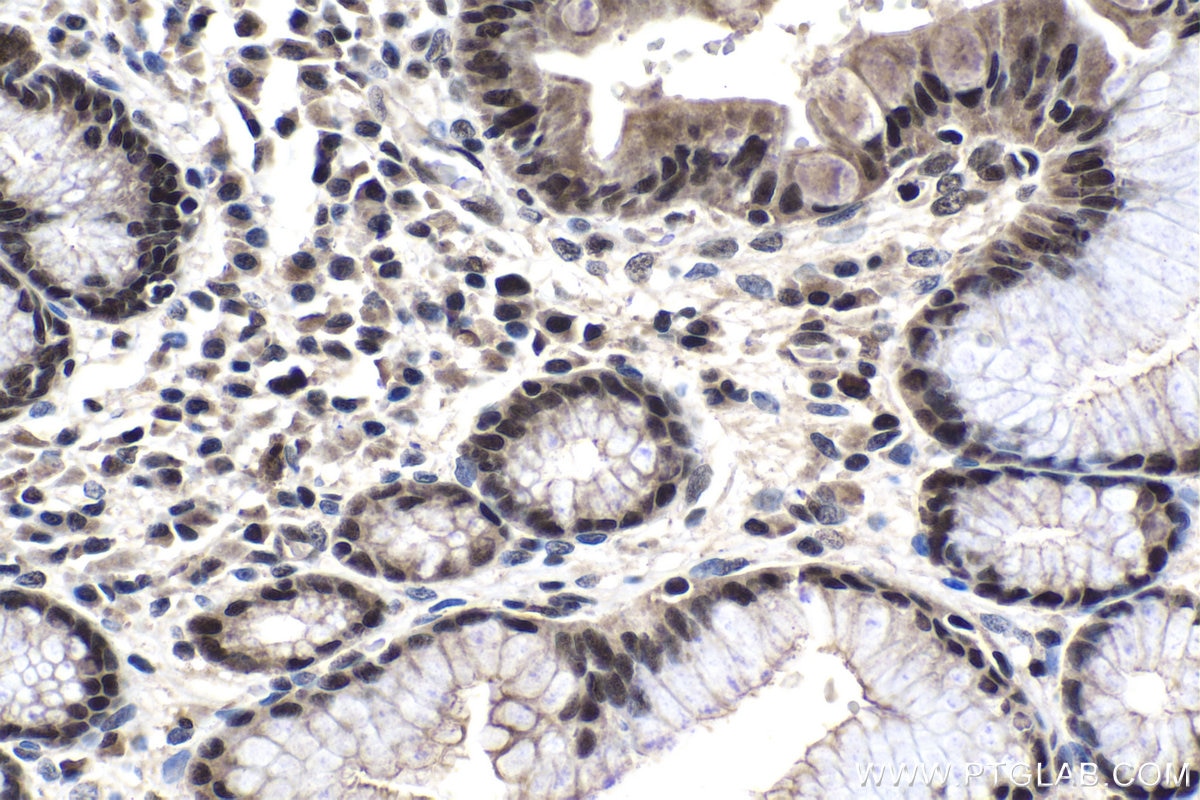 Immunohistochemistry (IHC) staining of human stomach cancer tissue using ILKAP Polyclonal antibody (16017-1-AP)