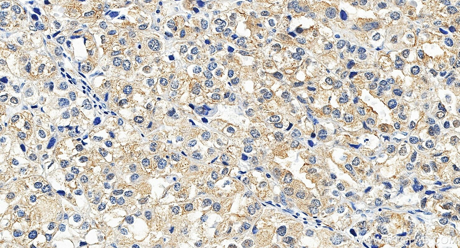 IHC staining of human endometrial cancer using 28422-1-AP Immunohistochemistry (IHC) staining of human endometrial cancer tissue using ILT-3/LILRB4 Polyclonal antibody (28422-1-AP)