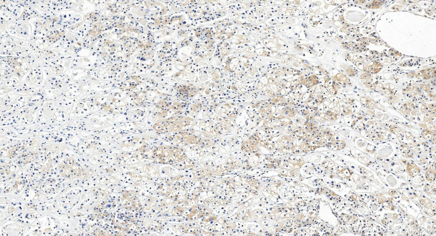 IHC staining of human endometrial cancer using 28422-1-AP Immunohistochemistry (IHC) staining of human endometrial cancer tissue using ILT-3/LILRB4 Polyclonal antibody (28422-1-AP)