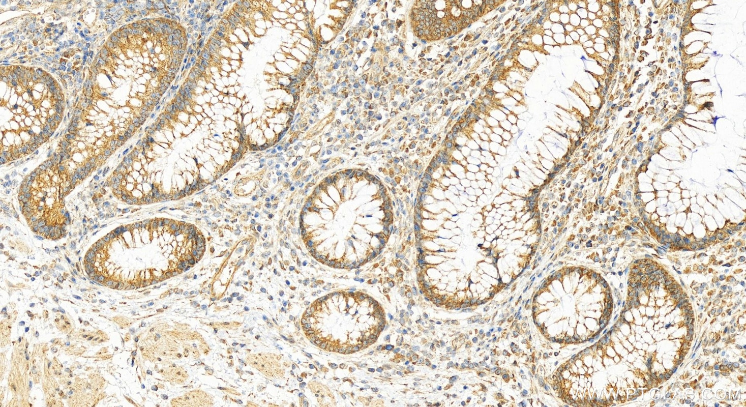 Immunohistochemistry (IHC) staining of human colon cancer tissue using ILVBL Polyclonal antibody (11220-1-AP)