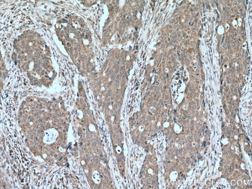 Immunohistochemistry (IHC) staining of human colon cancer tissue using ILVBL Polyclonal antibody (11220-1-AP)