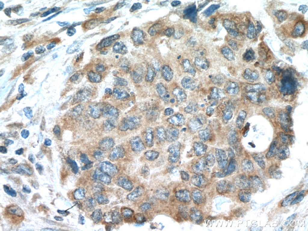 Immunohistochemistry (IHC) staining of human colon cancer tissue using ILVBL Polyclonal antibody (11220-1-AP)