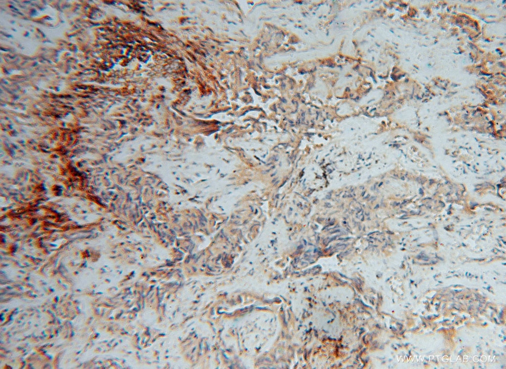 Immunohistochemistry (IHC) staining of human lung cancer tissue using IMMP2L Polyclonal antibody (15970-1-AP)