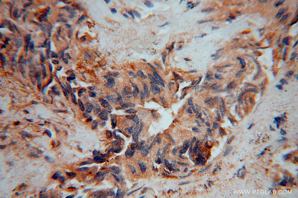 Immunohistochemistry (IHC) staining of human lung cancer tissue using IMMP2L Polyclonal antibody (15970-1-AP)
