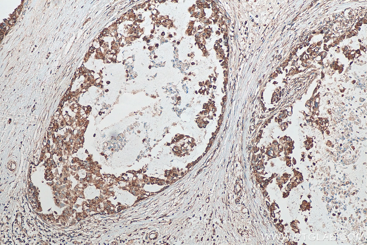 Immunohistochemistry (IHC) staining of human breast cancer tissue using Mitofilin Polyclonal antibody (10179-1-AP)