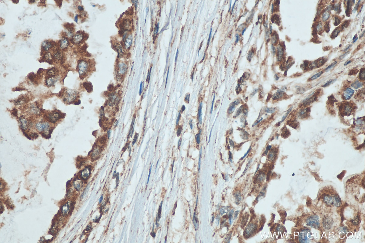 Immunohistochemistry (IHC) staining of human breast cancer tissue using Mitofilin Polyclonal antibody (10179-1-AP)