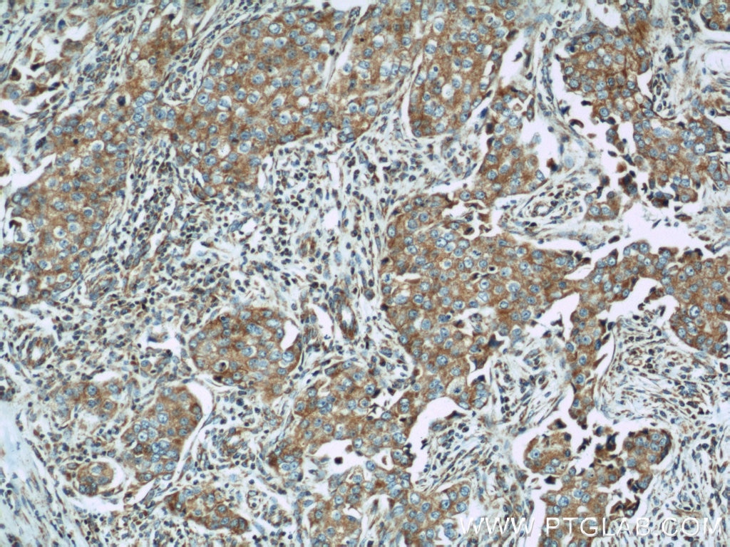 Immunohistochemistry (IHC) staining of human breast cancer tissue using Mitofilin Polyclonal antibody (10179-1-AP)