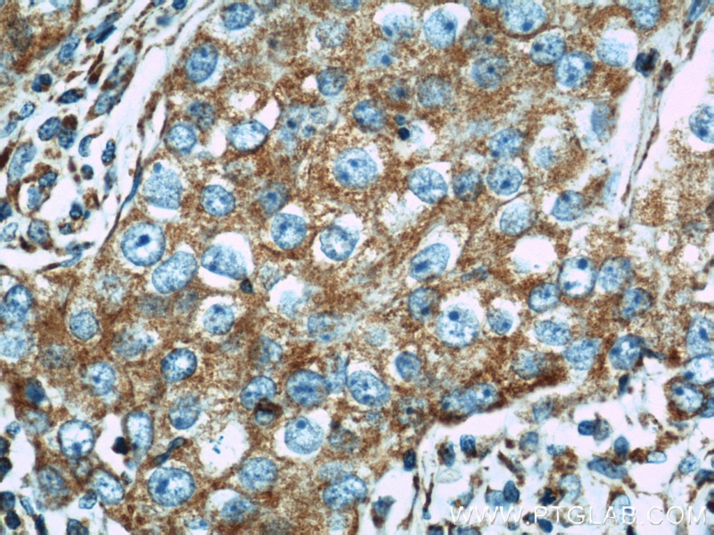 Immunohistochemistry (IHC) staining of human breast cancer tissue using Mitofilin Polyclonal antibody (10179-1-AP)