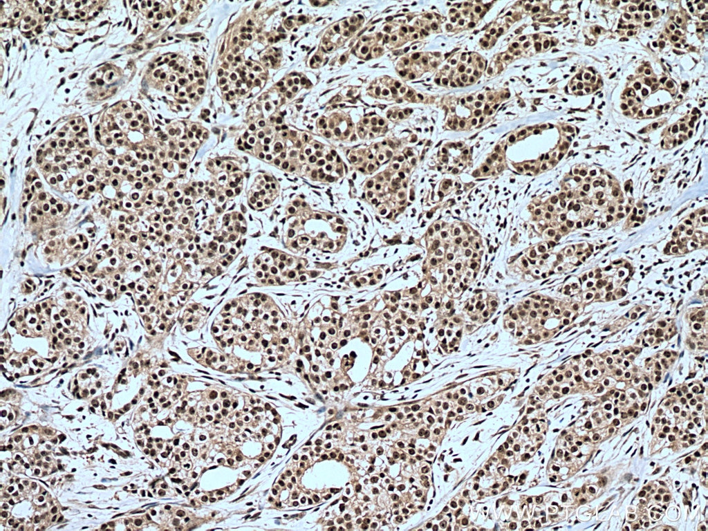 Immunohistochemistry (IHC) staining of human breast cancer tissue using IMP3 Monoclonal antibody (66247-1-Ig)