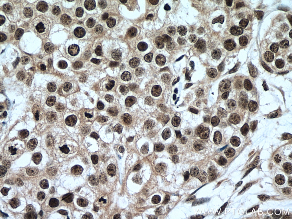 Immunohistochemistry (IHC) staining of human breast cancer tissue using IMP3 Monoclonal antibody (66247-1-Ig)