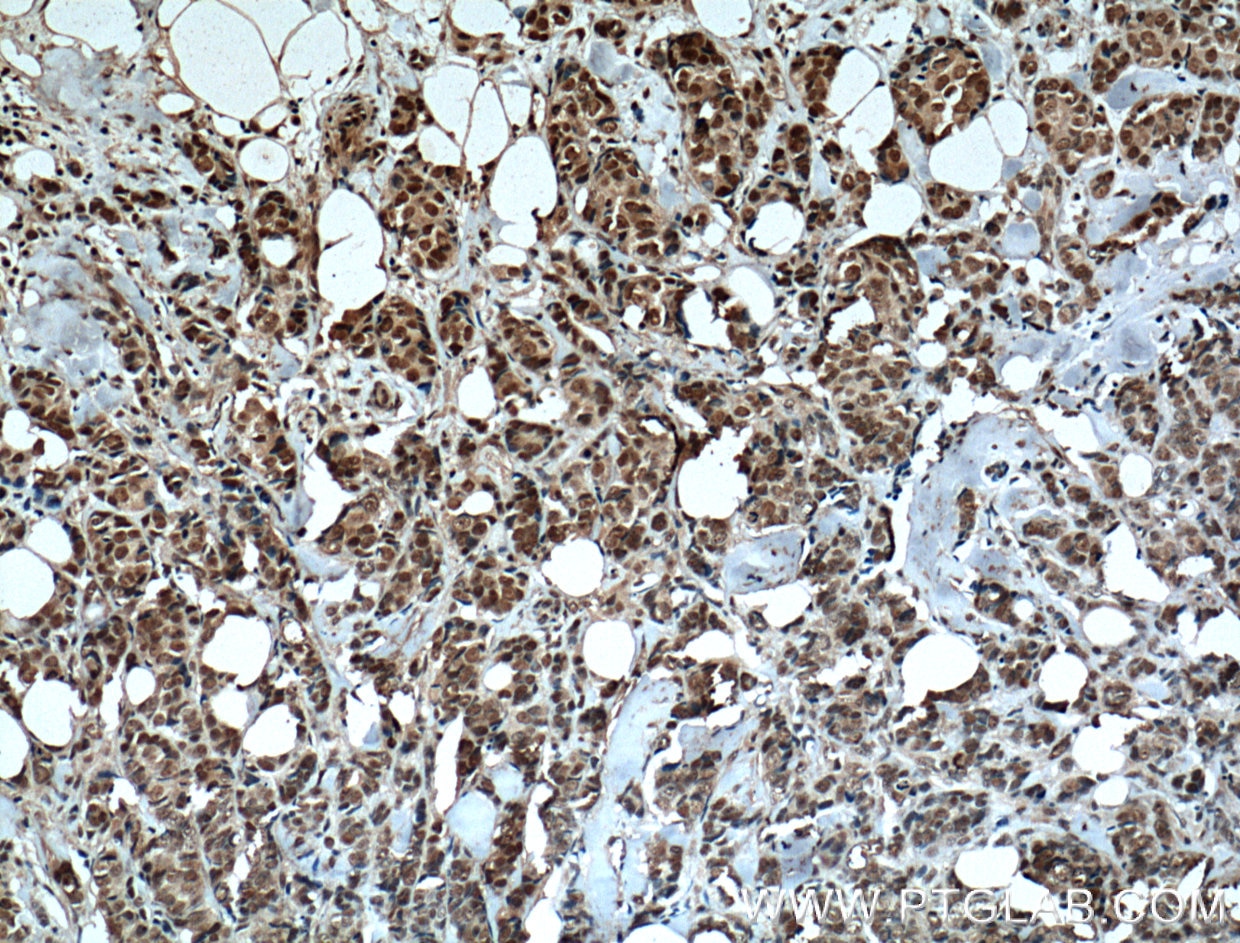 Immunohistochemistry (IHC) staining of human breast cancer tissue using IMP3 Monoclonal antibody (66247-1-Ig)