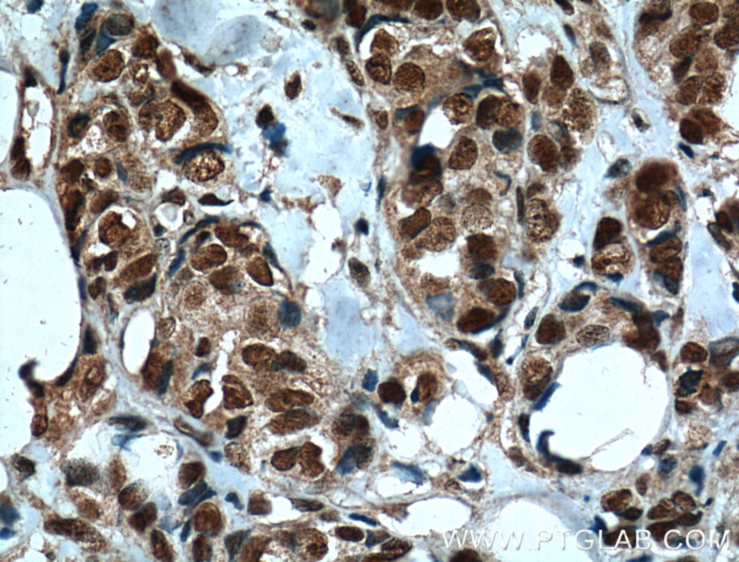 Immunohistochemistry (IHC) staining of human breast cancer tissue using IMP3 Monoclonal antibody (66247-1-Ig)