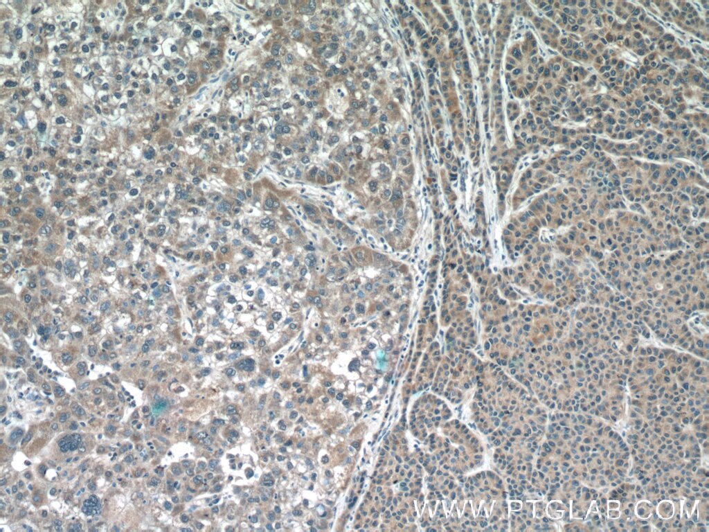 IHC staining of human liver cancer using 12664-1-AP