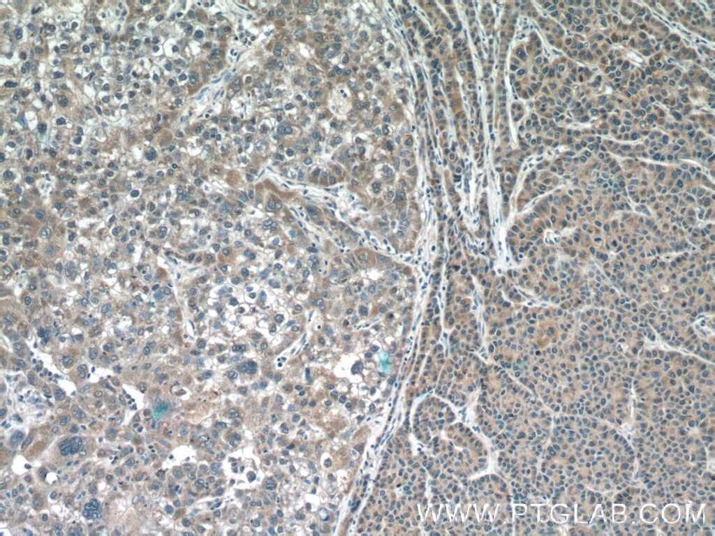 Immunohistochemistry (IHC) staining of human liver cancer tissue using IMP5 Polyclonal antibody (12664-1-AP)
