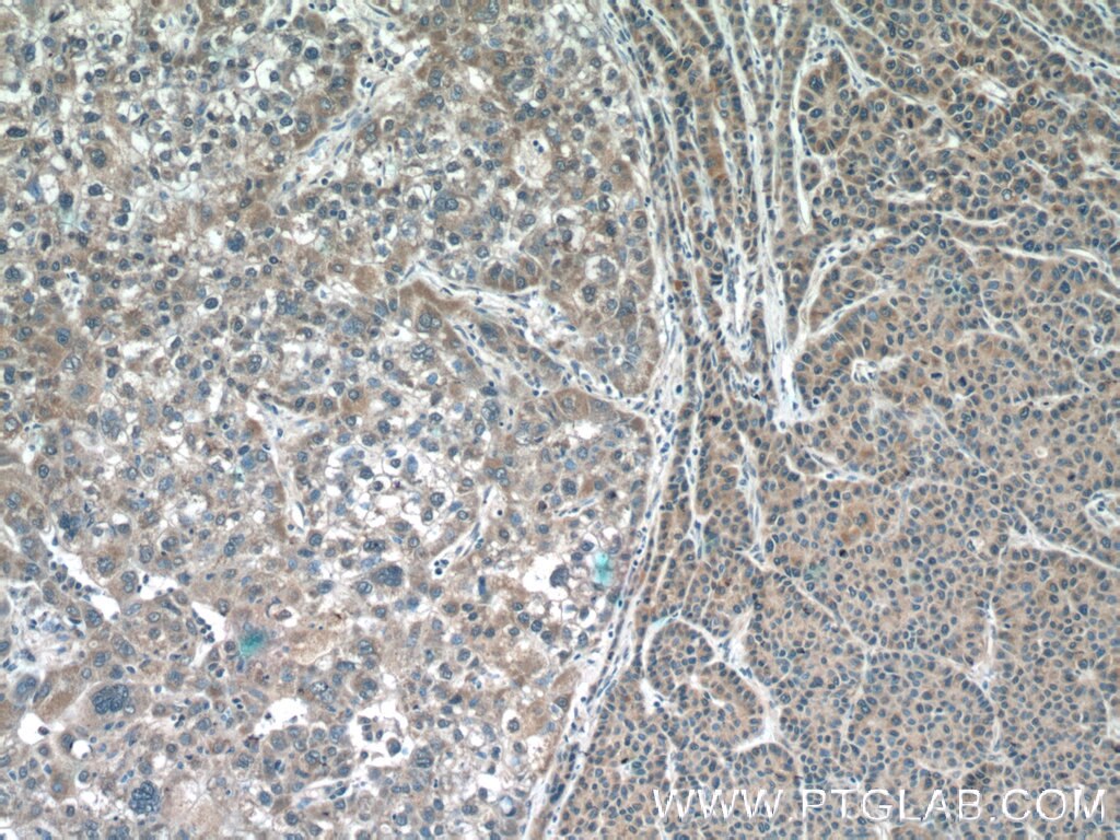 Immunohistochemistry (IHC) staining of human liver cancer tissue using IMP5 Polyclonal antibody (12664-1-AP)