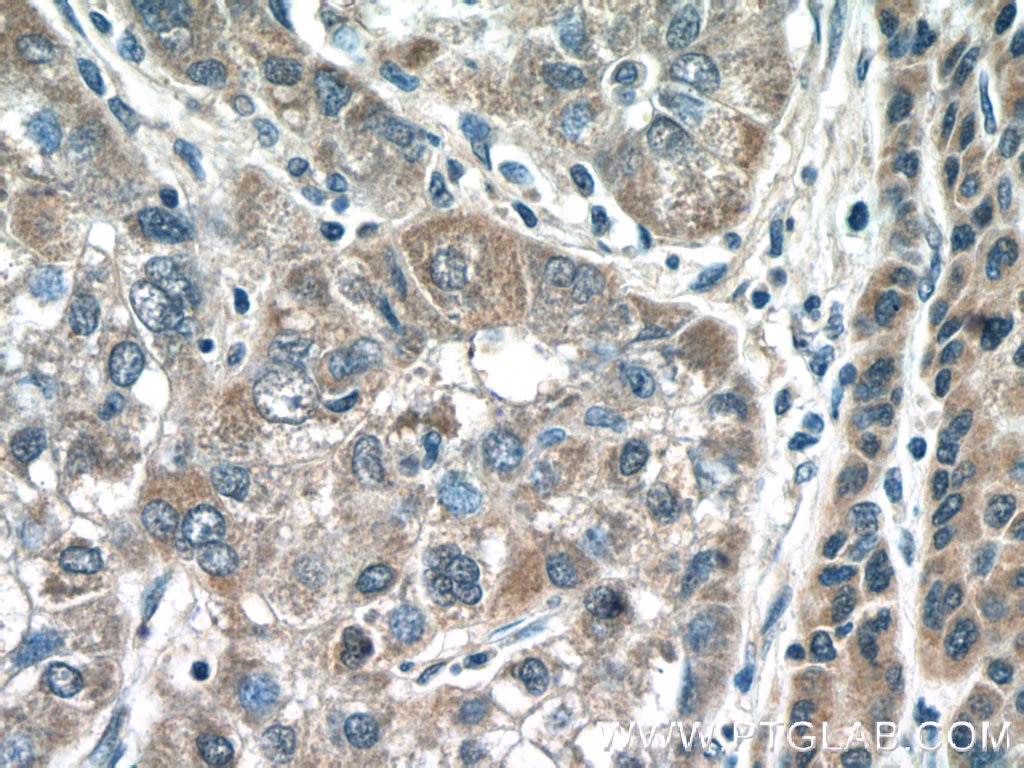 Immunohistochemistry (IHC) staining of human liver cancer tissue using IMP5 Polyclonal antibody (12664-1-AP)