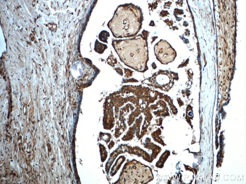 Immunohistochemistry (IHC) staining of human ovary tumor tissue using IMPDH1 Polyclonal antibody (22092-1-AP)