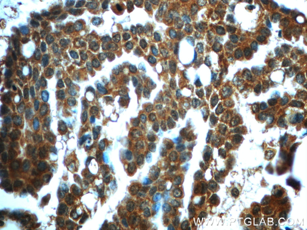 Immunohistochemistry (IHC) staining of human ovary tumor tissue using IMPDH1 Polyclonal antibody (22092-1-AP)