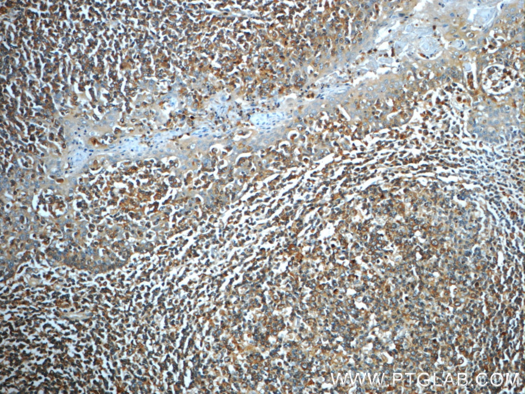 Immunohistochemistry (IHC) staining of human tonsillitis tissue using IMPDH1 Polyclonal antibody (22092-1-AP)