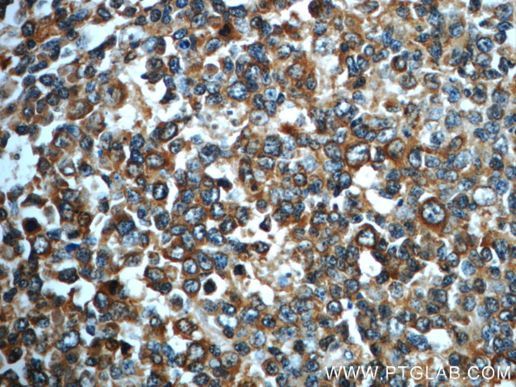 Immunohistochemistry (IHC) staining of human tonsillitis tissue using IMPDH1 Polyclonal antibody (22092-1-AP)