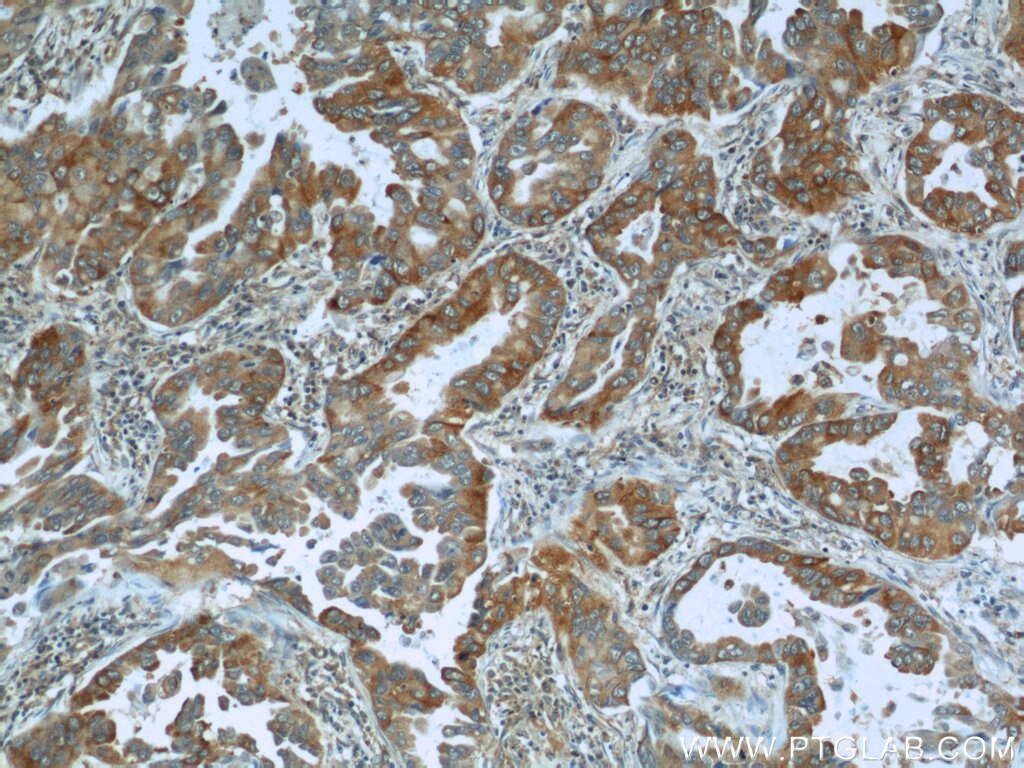IHC staining of human lung cancer using 12948-1-AP