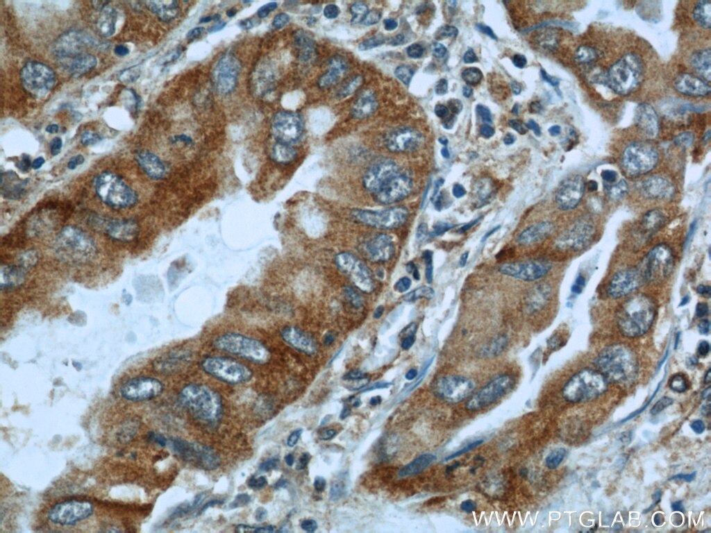 IHC staining of human lung cancer using 12948-1-AP