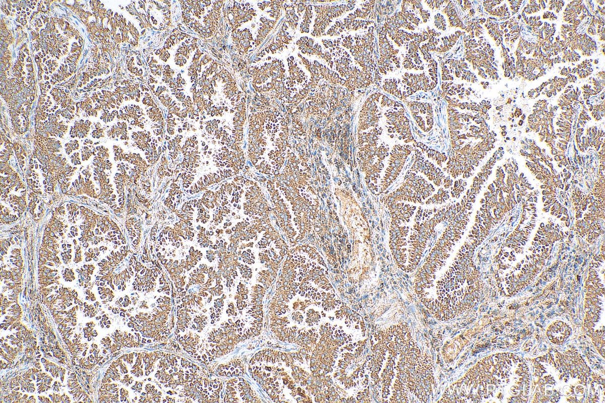 Immunohistochemistry (IHC) staining of human lung cancer tissue using IMPDH2 Polyclonal antibody (12948-1-AP)