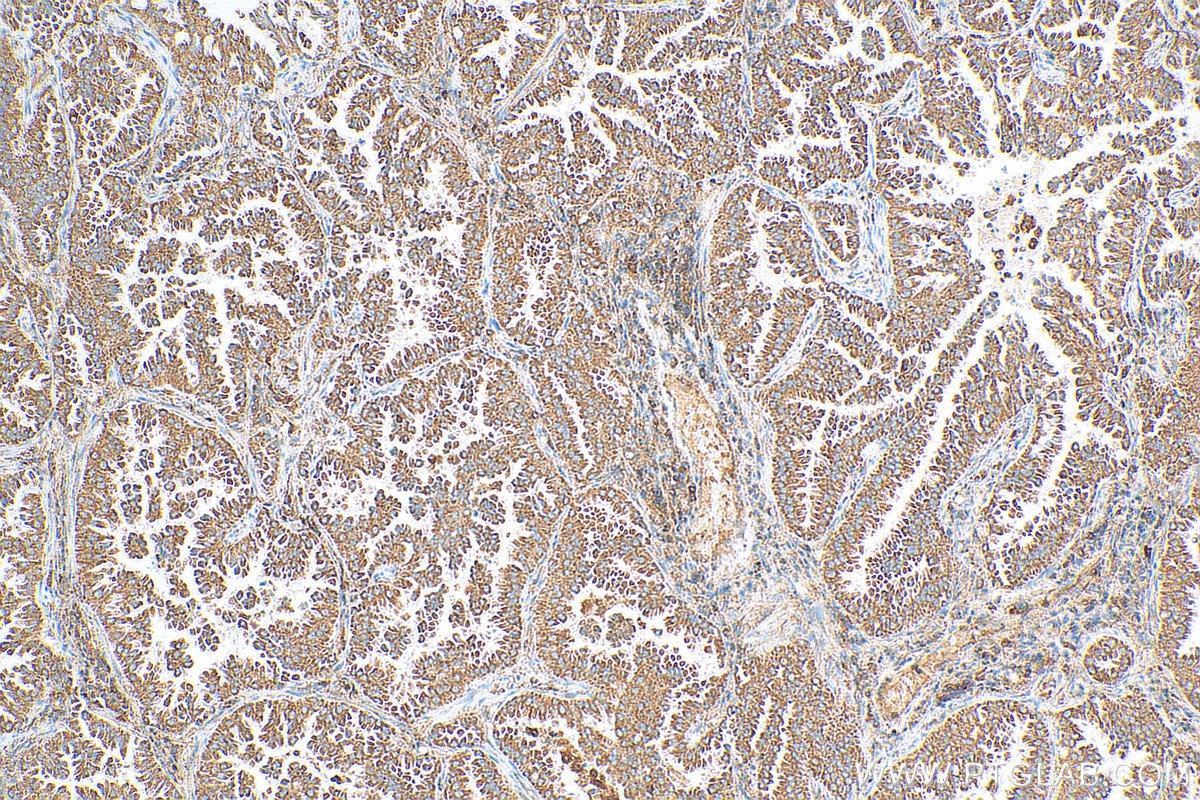 IHC staining of human lung cancer using 12948-1-AP