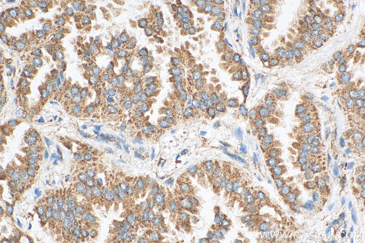 Immunohistochemistry (IHC) staining of human lung cancer tissue using IMPDH2 Polyclonal antibody (12948-1-AP)