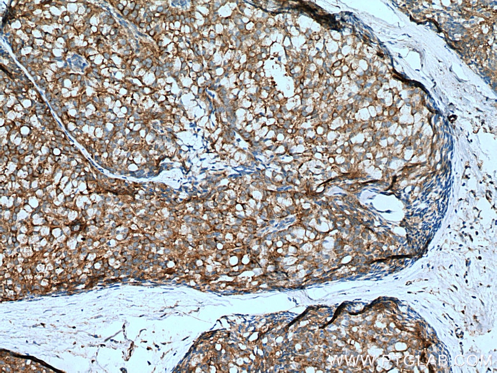 IHC staining of human breast hyperplasia using 67663-1-Ig