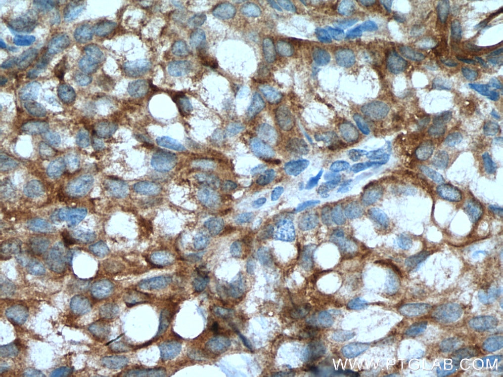 Immunohistochemistry (IHC) staining of human breast hyperplasia tissue using IMPDH2 Monoclonal antibody (67663-1-Ig)